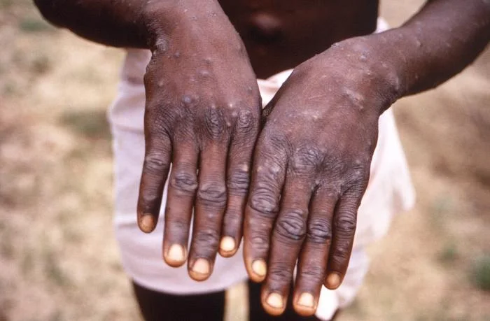 WHO: Mpox Is Not the New COVID, But We Must Act Now