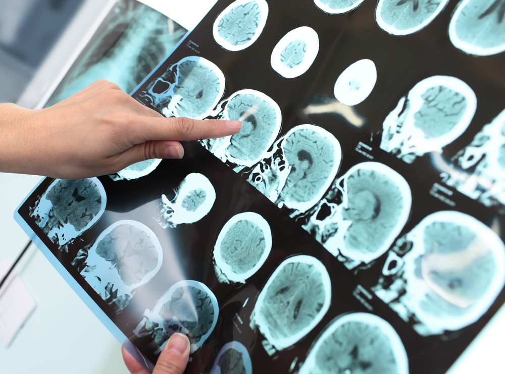 How Swimming Could Shield Your Brain From Alzheimer’s, According to Doctors