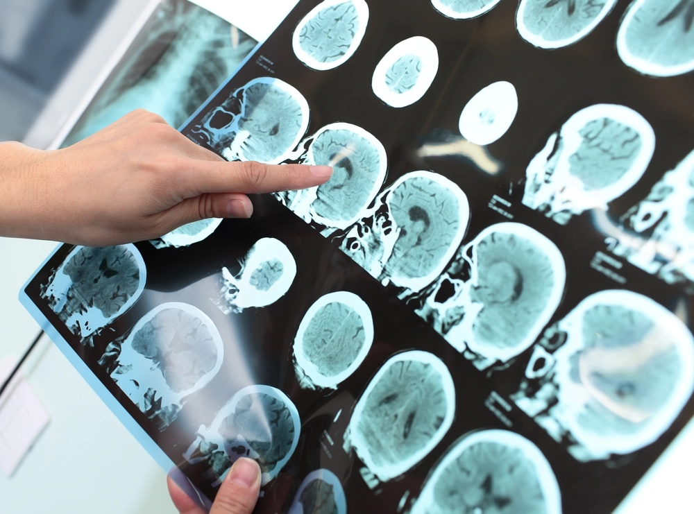 How Swimming Could Shield Your Brain From Alzheimer’s, According to Doctors