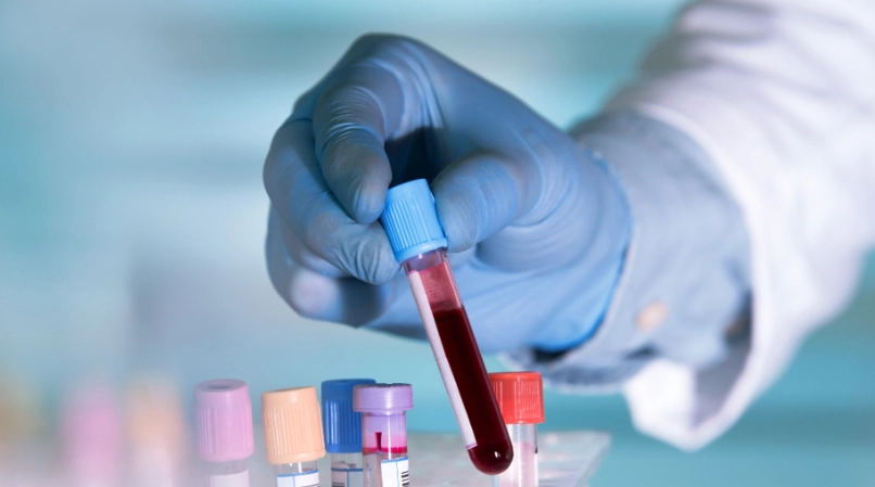 Scientists Discover Blood Test for Detecting Alzheimer’s