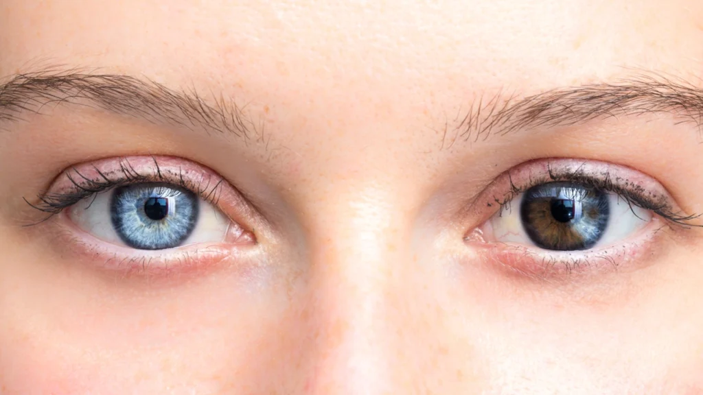 This boy’s eyes turned from brown to blue after a Covid treatment: Here’s why
