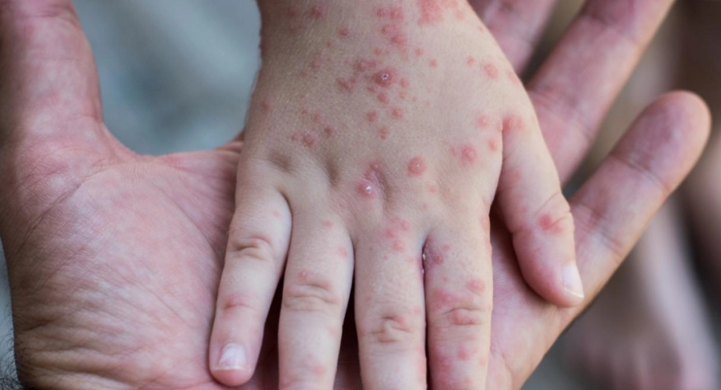 First Mpox Case in Europe: Doctor Warns of New Variant’s Risks