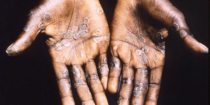 Mpox Outbreak in Africa: Emergent Donates 50,000 Vaccine Doses