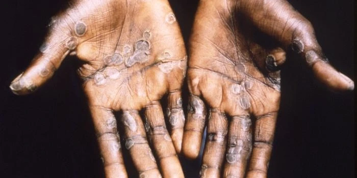 Mpox Outbreak in Africa: Emergent Donates 50,000 Vaccine Doses