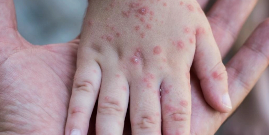 South Africa Reports Second Mpox Death in a Week