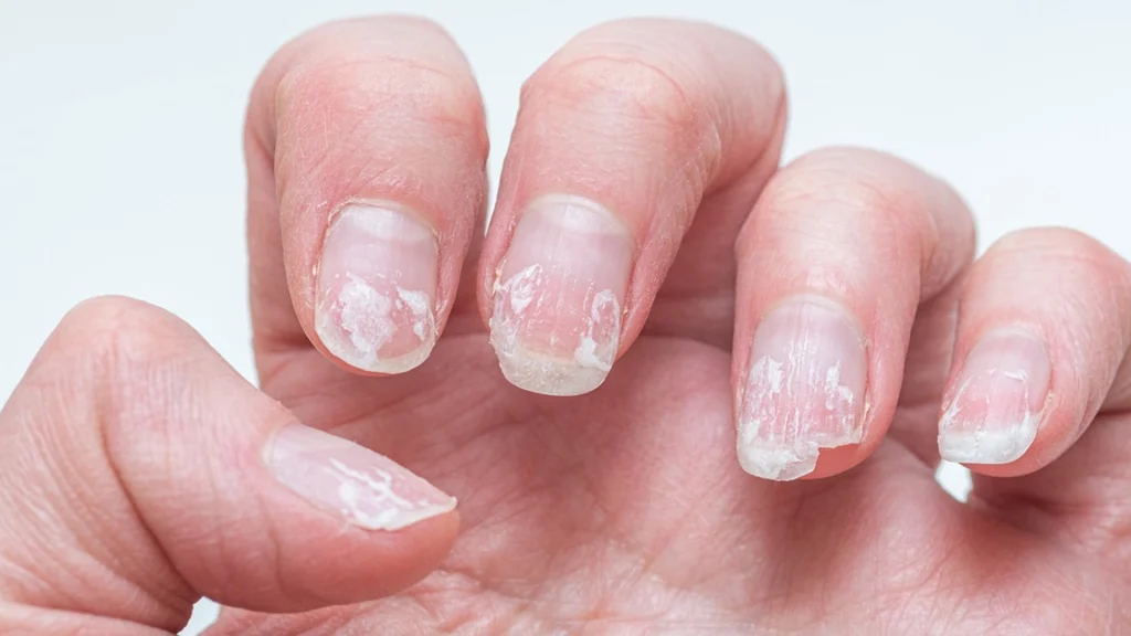 Do You Have Ridged Nails? Here’s What They Might Be Telling You About Your Health
