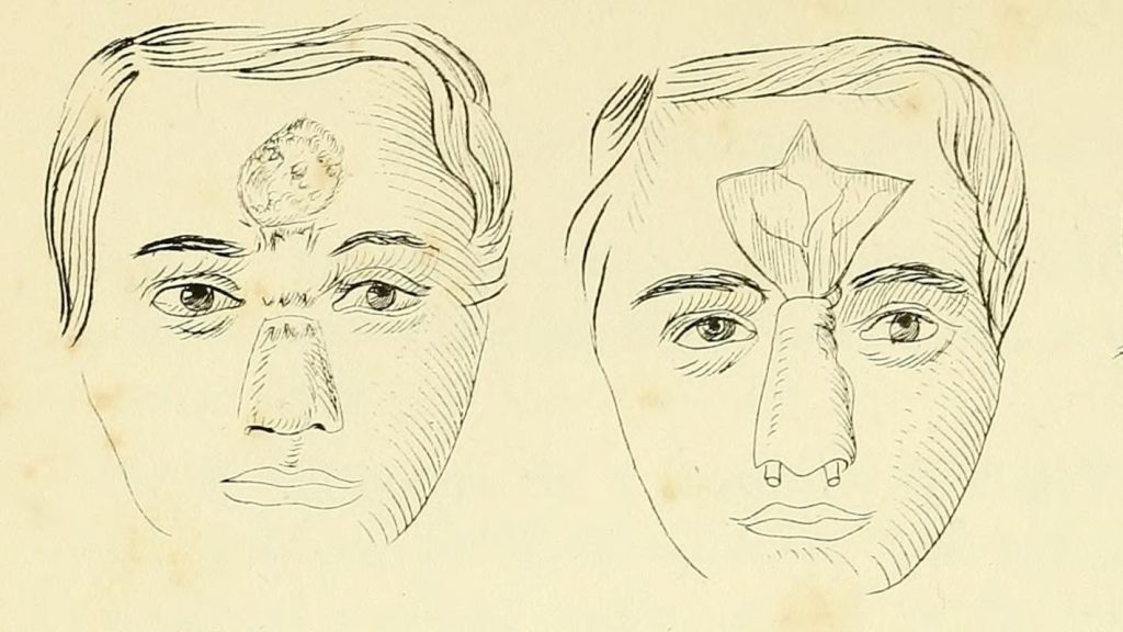 Unfaithful Indians Turned to Ancient Plastic Surgery