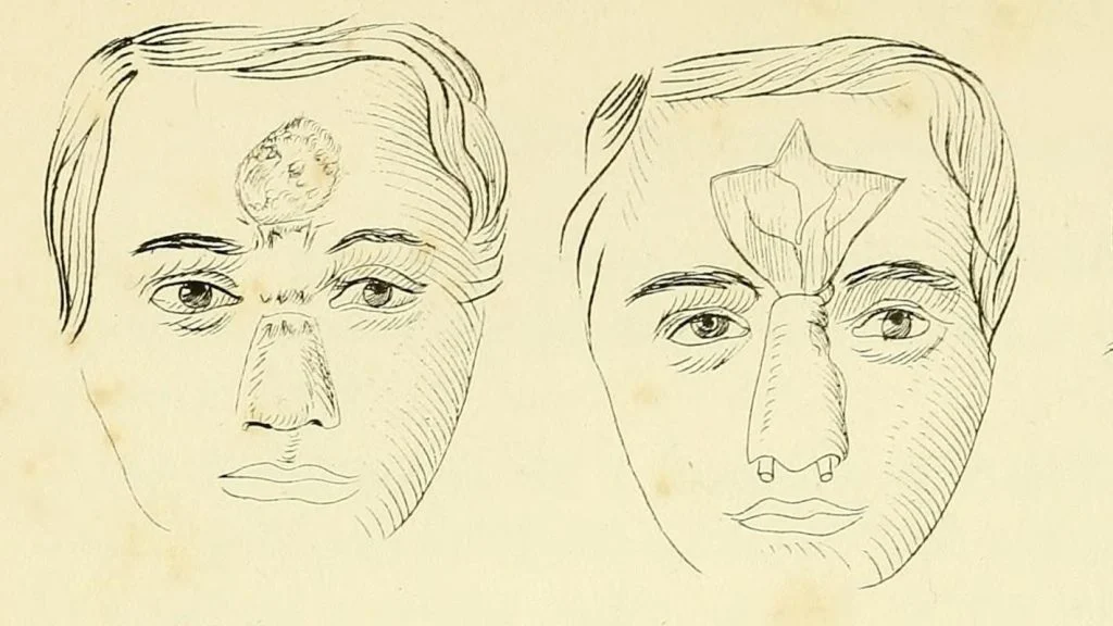 Unfaithful Indians Turned to Ancient Plastic Surgery