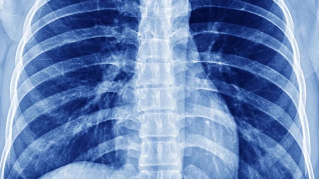 This disease has a mortality rate of 100%
