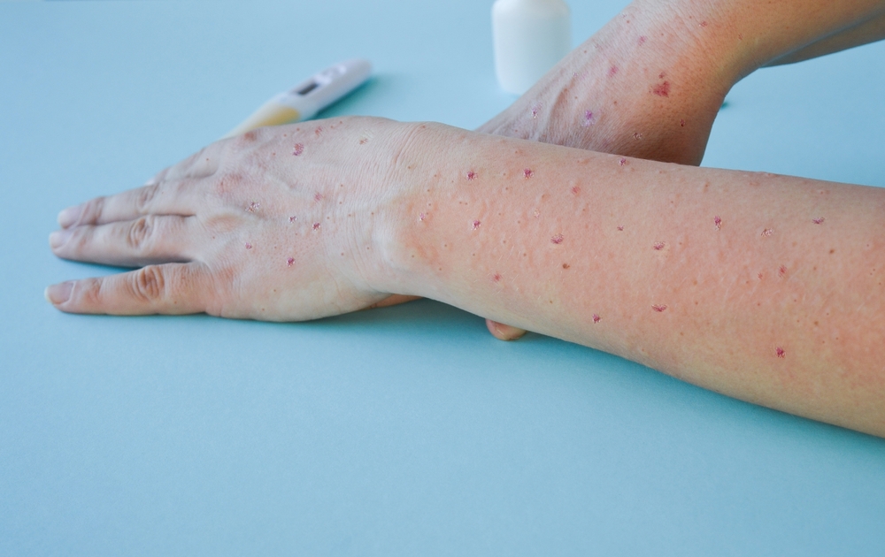 WHO Considers New Global Health Alert for Monkeypox