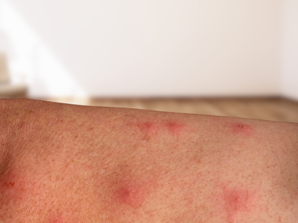 Mpox Variant Cases Confirmed in UK and 10 Other Countries