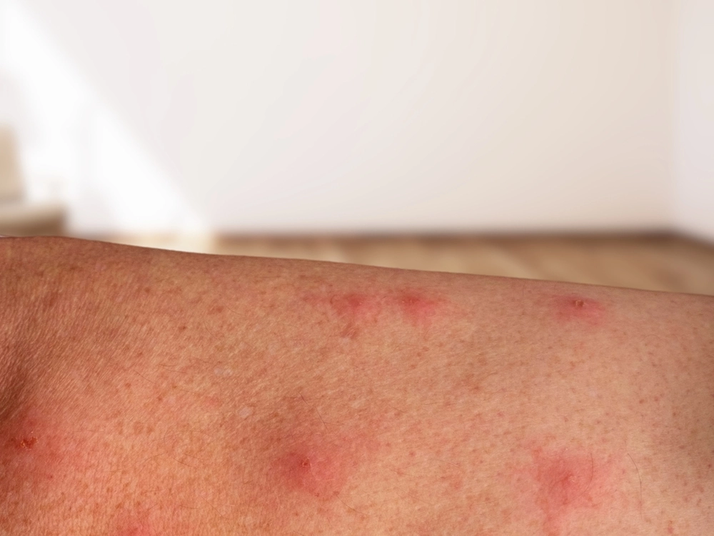 Mpox Variant Cases Confirmed in UK and 10 Other Countries