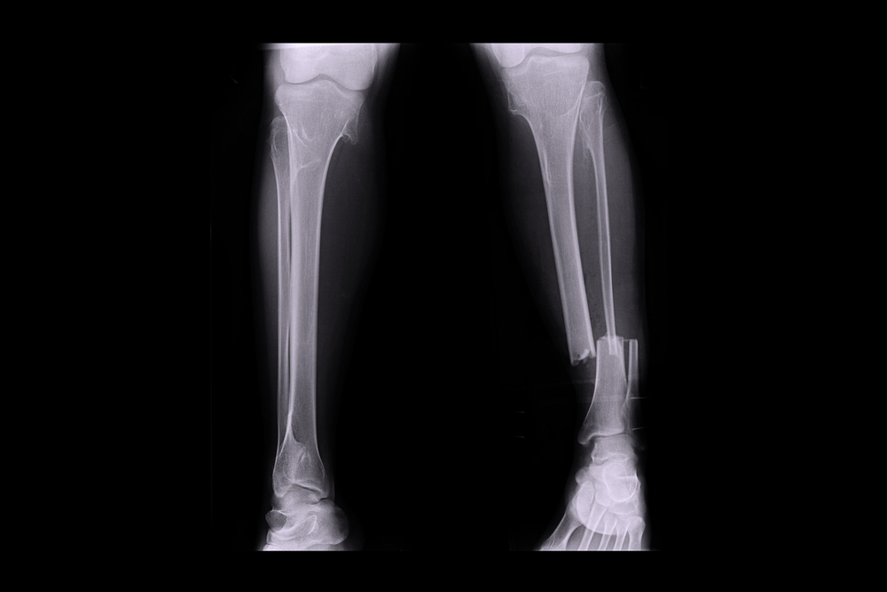 Russia with Major Medical Breakthrough: New Innovative Treatment for Complex Fractures