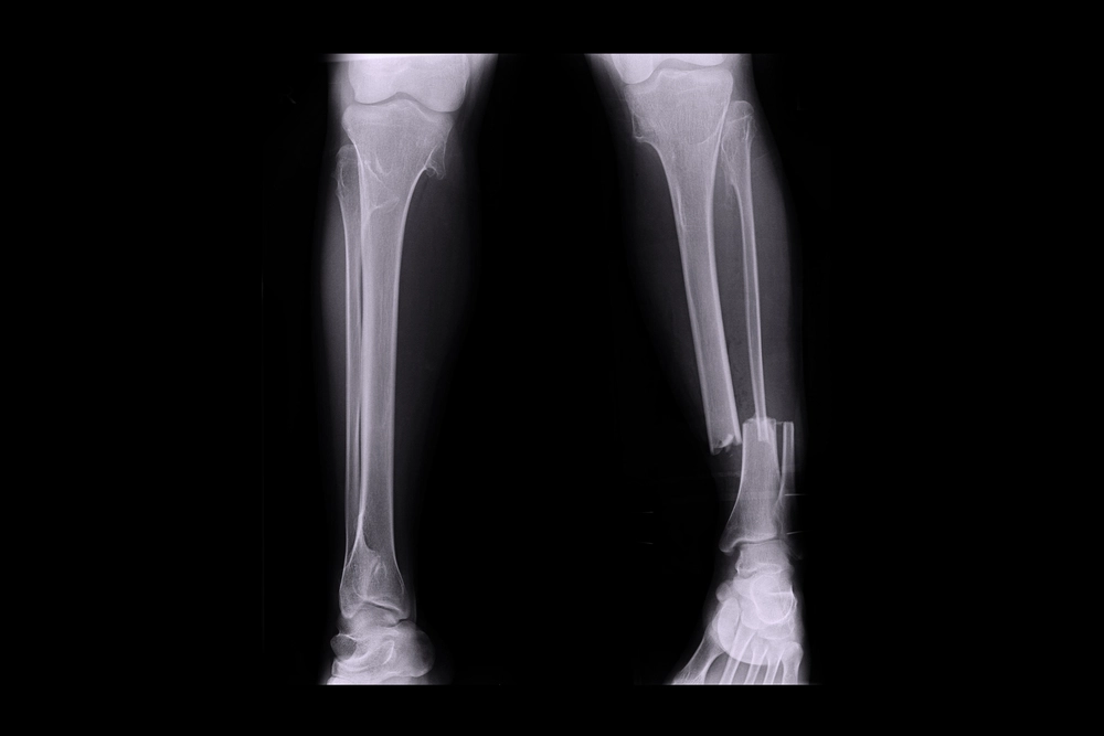 Russia with Major Medical Breakthrough: New Innovative Treatment for Complex Fractures