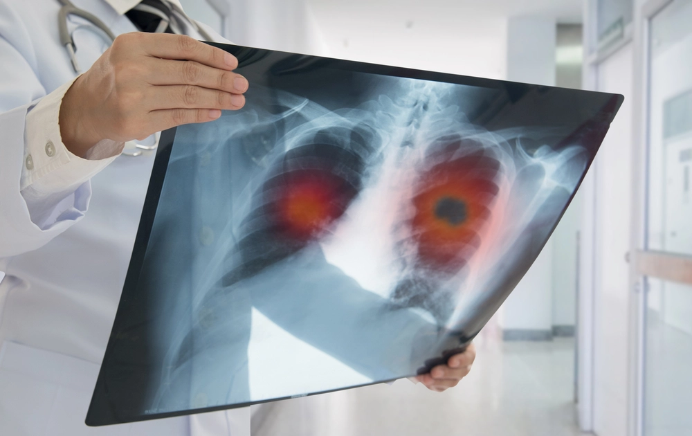 Do You Taste That? How Lung Cancer Makes Its Presence Known