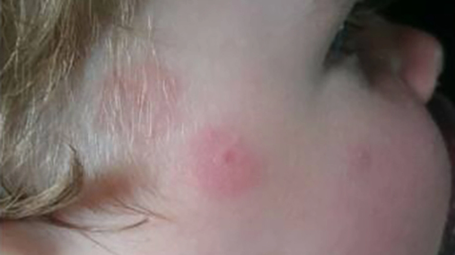 If you see this mark on your child, Rush to the ER immediately