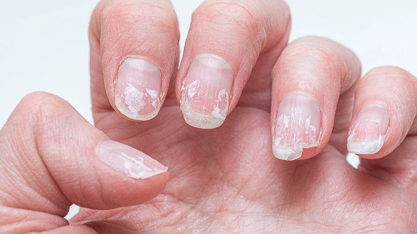 Frequently Splitting Your Nails? Here’s the Reason and Solution