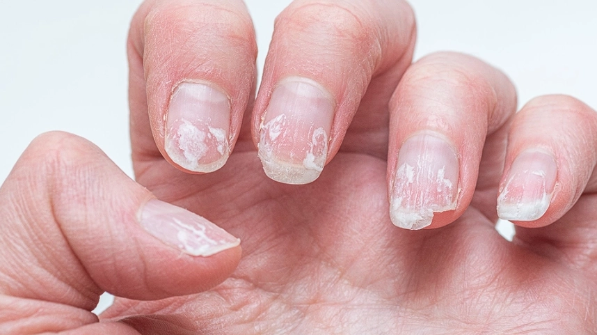 Frequently Splitting Your Nails? Here’s the Reason and Solution
