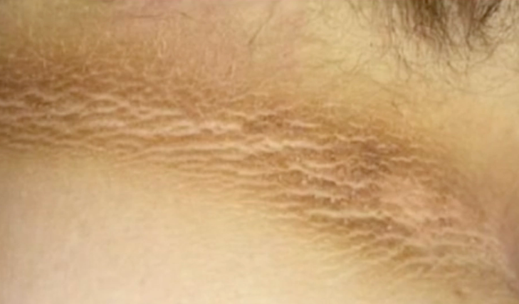 Dark Markings on the Neck? Often a Symptom of This Disease