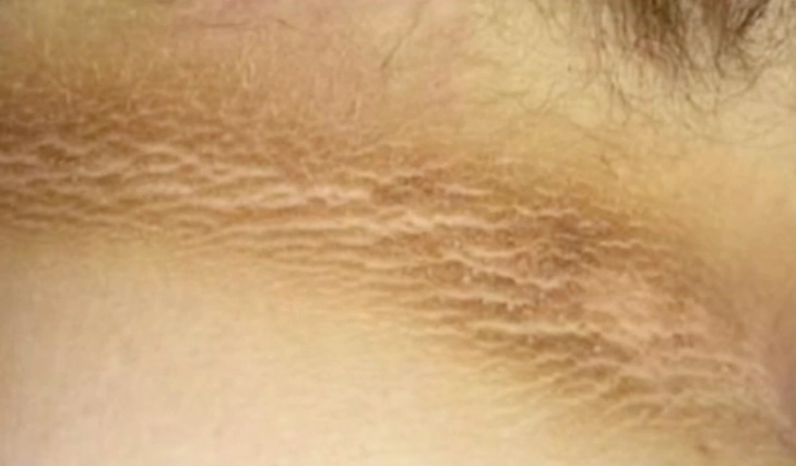 Dark Markings on the Neck? Often a Symptom of This Disease