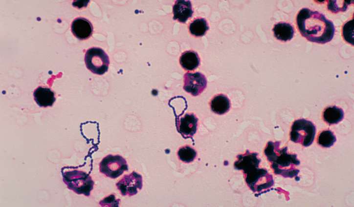 Mysterious Bacterial Infection with High Mortality Rate Spreads in Japan