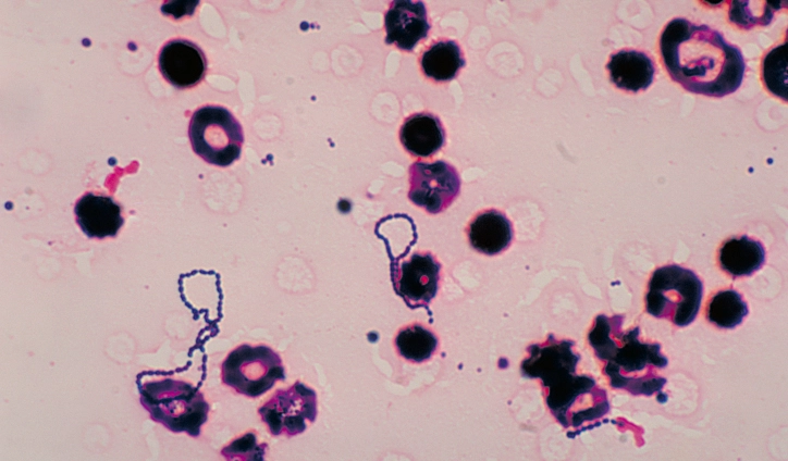 Mysterious Bacterial Infection with High Mortality Rate Spreads in Japan