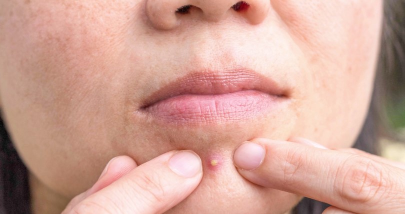 Dermatologists Warn: Popping Pimples in This Area Can Be Deadly