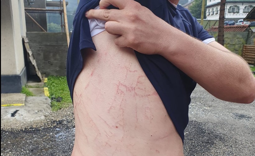 Man Survives Lightning Strike and Shares Advice for Other Hikers